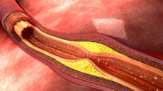 lowering-cholesterol-internal-medicine-insights